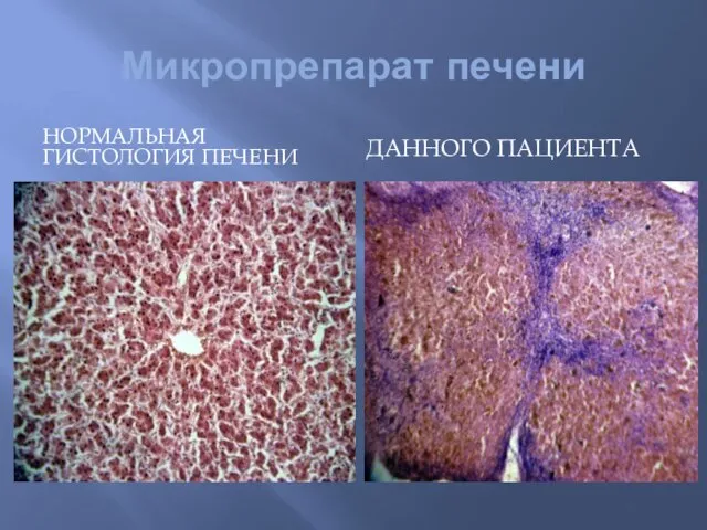 Микропрепарат печени ДАННОГО ПАЦИЕНТА НОРМАЛЬНАЯ ГИСТОЛОГИЯ ПЕЧЕНИ