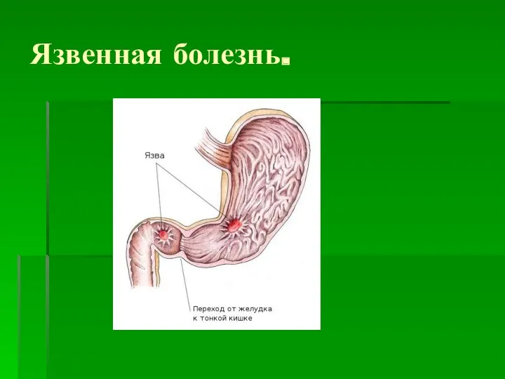 Язвенная болезнь.