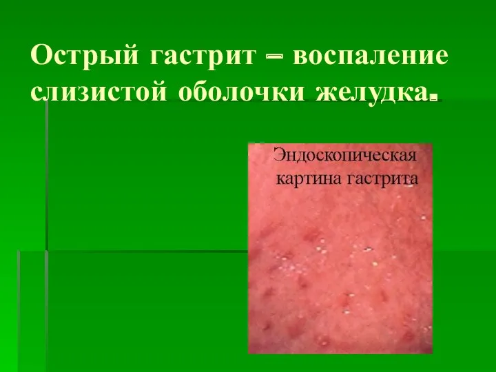 Острый гастрит – воспаление слизистой оболочки желудка.