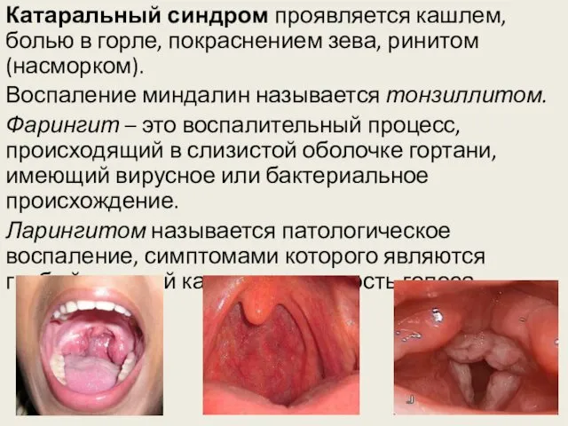 Катаральный синдром проявляется кашлем, болью в горле, покраснением зева, ринитом (насморком). Воспаление миндалин