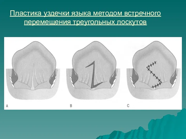 Пластика уздечки языка методом встречного перемещения треугольных лоскутов