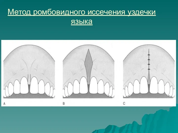 Метод ромбовидного иссечения уздечки языка