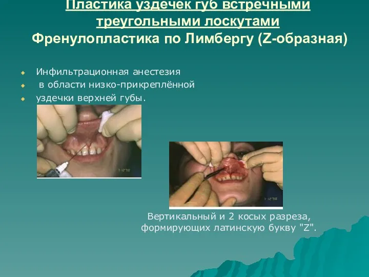 Пластика уздечек губ встречными треугольными лоскутами Френулопластика по Лимбергу (Z-образная)