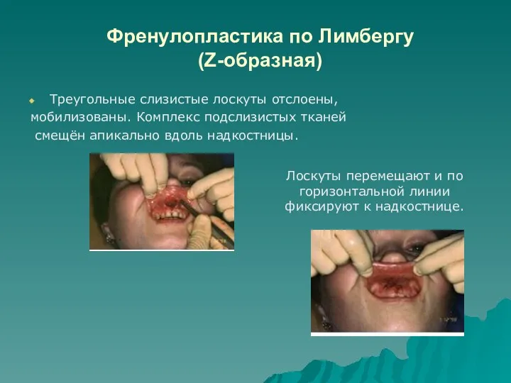 Френулопластика по Лимбергу (Z-образная) Треугольные слизистые лоскуты отслоены, мобилизованы. Комплекс