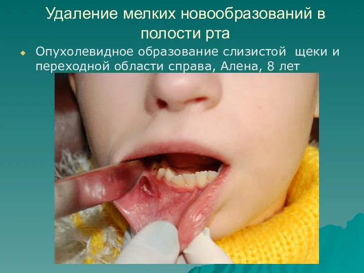 Удаление мелких новообразований в полости рта Опухолевидное образование слизистой щеки