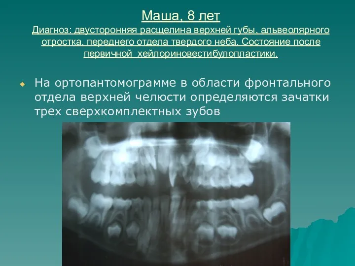 На ортопантомограмме в области фронтального отдела верхней челюсти определяются зачатки