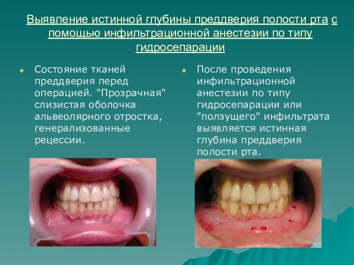 Выявление истинной глубины преддверия полости рта с помощью инфильтрационной анестезии