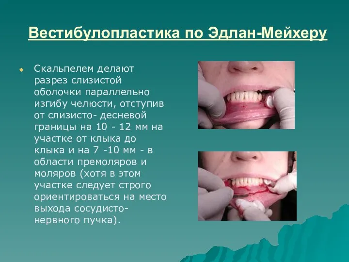 Вестибулопластика по Эдлан-Мейхеру Скальпелем делают разрез слизистой оболочки параллельно изгибу