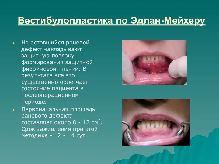 Вестибулопластика по Эдлан-Мейхеру На оставшийся раневой дефект накладывают защитную повязку