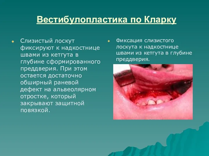 Вестибулопластика по Кларку Слизистый лоскут фиксируют к надкостнице швами из