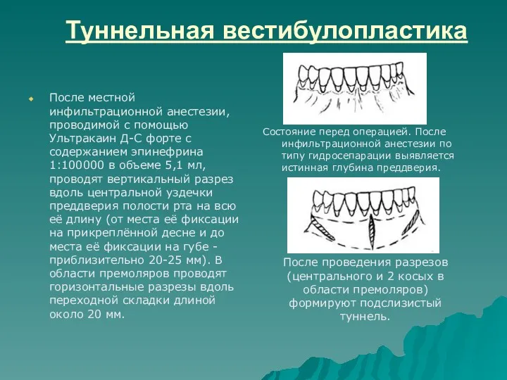 Туннельная вестибулопластика После местной инфильтрационной анестезии, проводимой с помощью Ультракаин