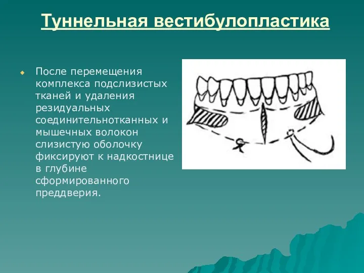 Туннельная вестибулопластика После перемещения комплекса подслизистых тканей и удаления резидуальных