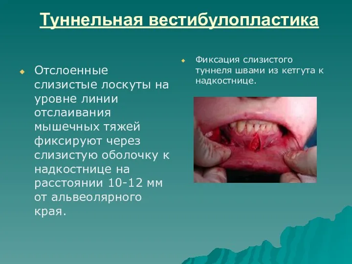 Туннельная вестибулопластика Отслоенные слизистые лоскуты на уровне линии отслаивания мышечных