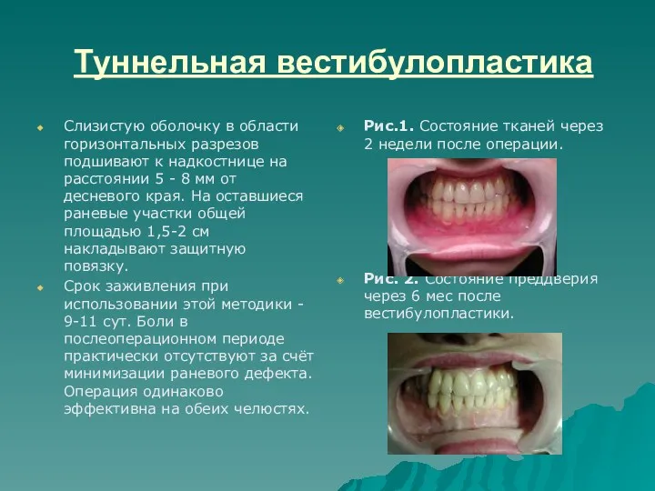 Туннельная вестибулопластика Слизистую оболочку в области горизонтальных разрезов подшивают к