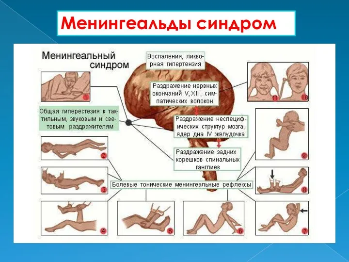 Менингеальды синдром