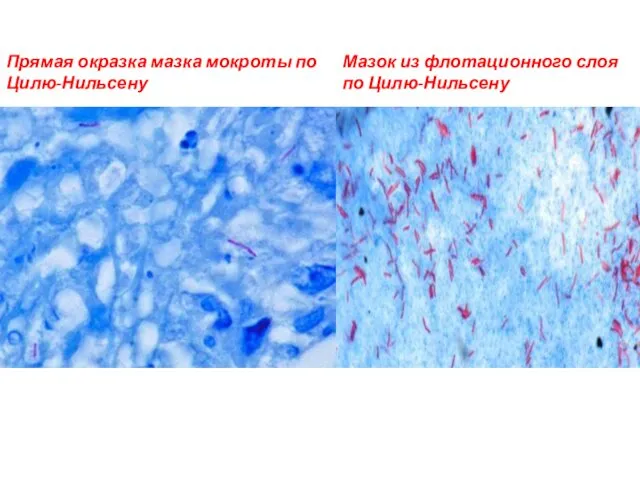 Прямая окразка мазка мокроты по Цилю-Нильсену Мазок из флотационного слоя по Цилю-Нильсену