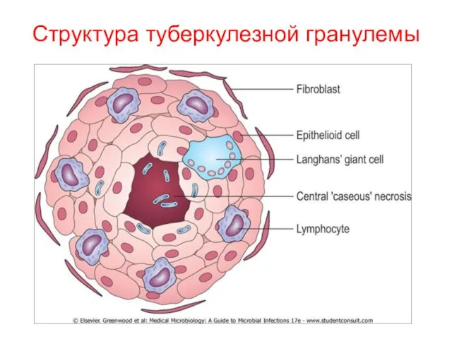 Структура туберкулезной гранулемы