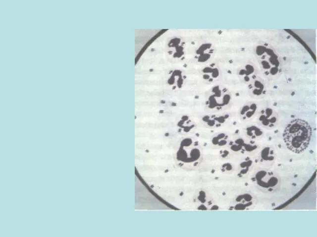 Менингококковый менингит Микроскопия ликвора: Внутри­клеточное расположение менингококков в спинномозговой жидкости.