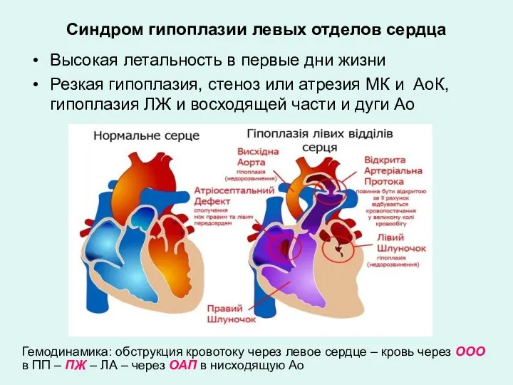 Синдром гипоплазии левых отделов сердца Высокая летальность в первые дни жизни Резкая гипоплазия,