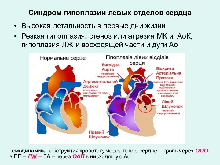 Синдром гипоплазии левых отделов сердца Высокая летальность в первые дни