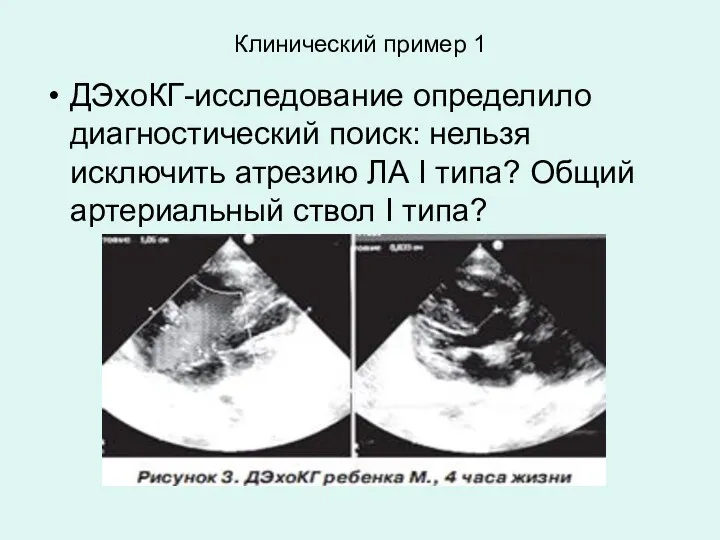 Клинический пример 1 ДЭхоКГ-исследование определило диагностический поиск: нельзя исключить атрезию ЛА I типа?