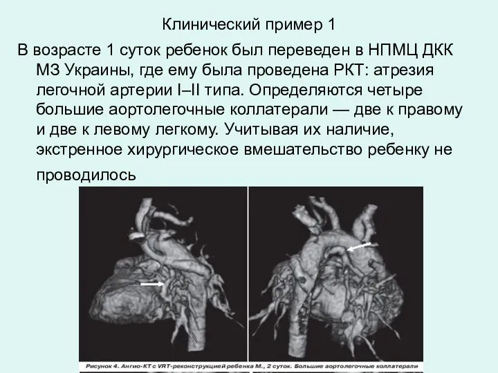 Клинический пример 1 В возрасте 1 суток ребенок был переведен