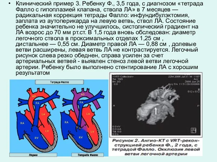 Клинический пример 3. Ребенку Ф., 3,5 года, с диагнозом «тетрада Фалло с гипоплазией