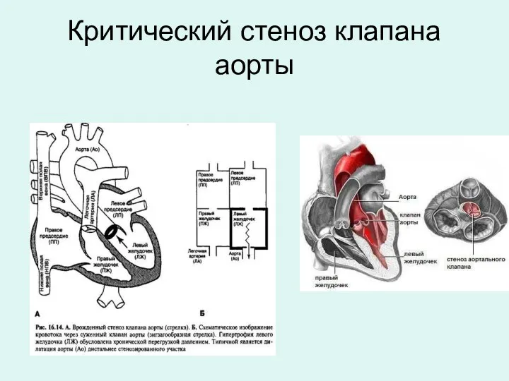 Критический стеноз клапана аорты