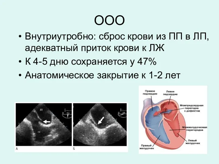 ООО Внутриутробно: сброс крови из ПП в ЛП, адекватный приток крови к ЛЖ