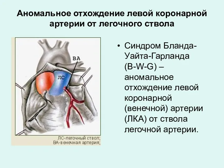 Аномальное отхождение левой коронарной артерии от легочного ствола Синдром Бланда-Уайта-Гарланда (B-W-G) – аномальное