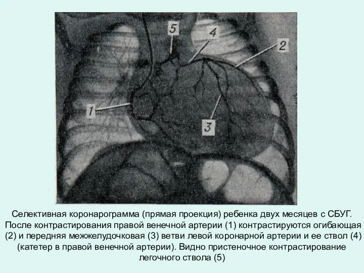 Селективная коронарограмма (прямая проекция) ребенка двух месяцев с СБУГ. После контрастирования правой венечной