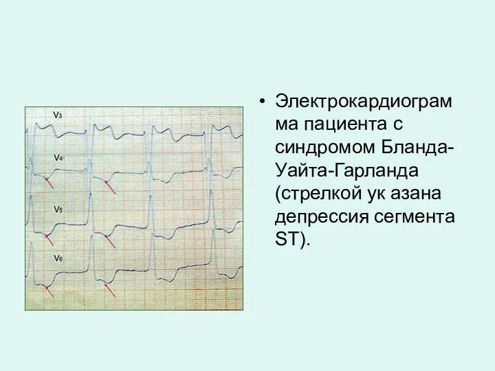 Электрокардиограмма пациента с синдромом Бланда-Уайта-Гарланда (стрелкой ук азана депрессия сегмента ST).