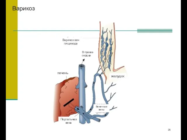 Варикоз печень Портальная вена Варикоз вен пищевода В правое сердце желудок Венечные вены