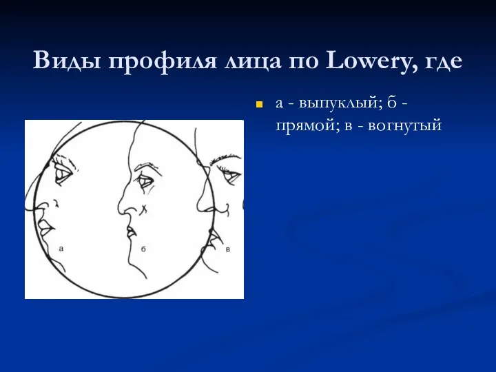 Виды профиля лица по Lowery, где а - выпуклый; б - прямой; в - вогнутый