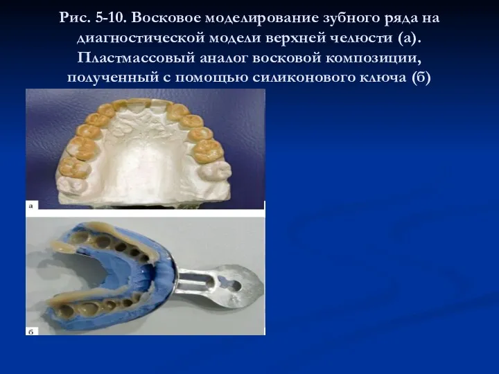 Рис. 5-10. Восковое моделирование зубного ряда на диагностической модели верхней