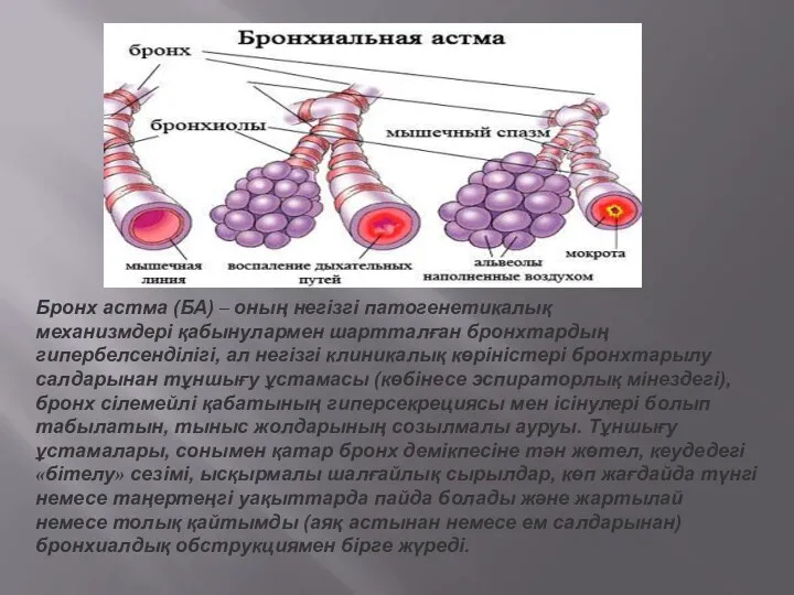 Бронх астма (БА) – оның негізгі патогенетикалық механизмдері қабынулармен шартталған