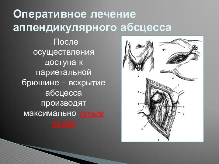 После осуществления доступа к париетальной брюшине – вскрытие абсцесса производят максимально тупым путём