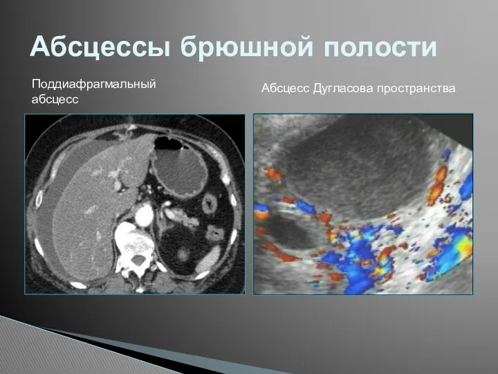 Абсцессы брюшной полости Поддиафрагмальный абсцесс Абсцесс Дугласова пространства