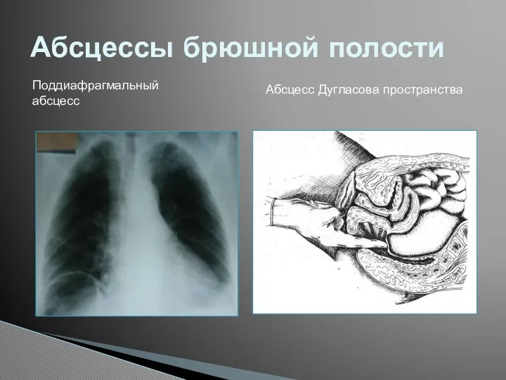 Абсцессы брюшной полости Поддиафрагмальный абсцесс Абсцесс Дугласова пространства
