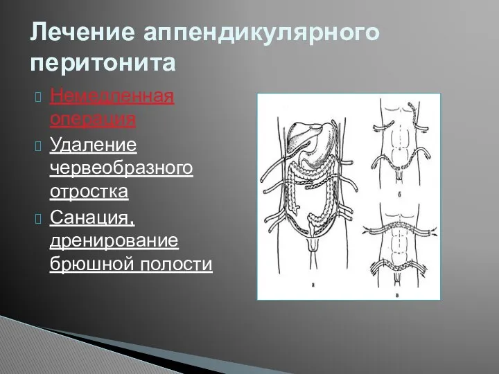 Немедленная операция Удаление червеобразного отростка Санация, дренирование брюшной полости Лечение аппендикулярного перитонита