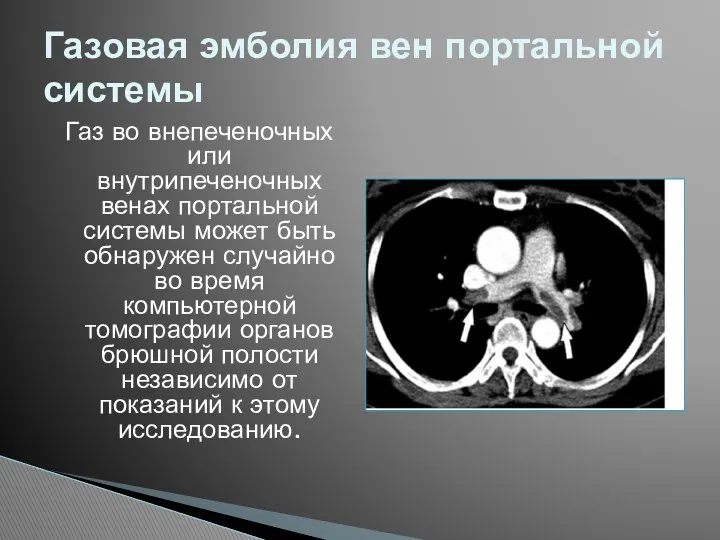 Газ во внепеченочных или внутрипеченочных венах портальной системы может быть обнаружен случайно во