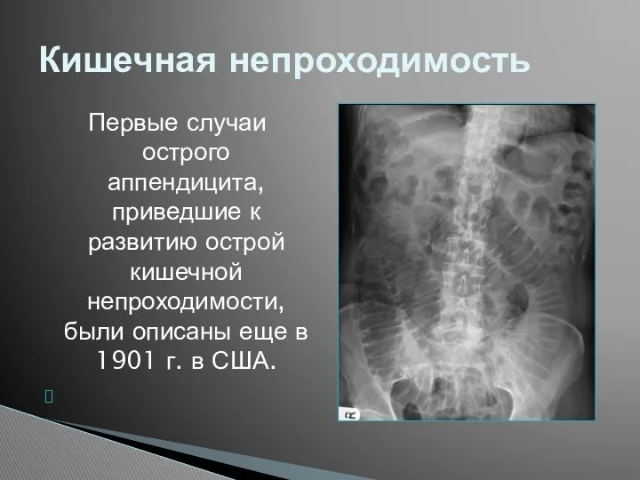 Первые случаи острого аппендицита, приведшие к развитию острой кишечной непроходимости,