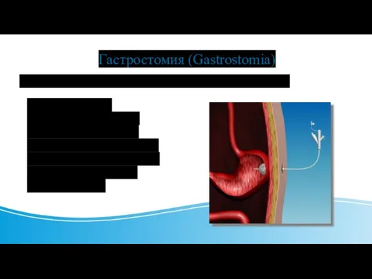 Гастростомия (Gastrostomia) - это наложение пищеприемного желудочного свища. То есть