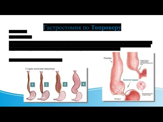 Гастростомия по Топроверу Показания: 1)рак пищевода 2)Ахалазия кардии - это