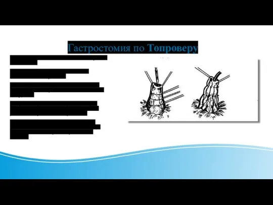 Гастростомия по Топроверу Переднюю стенку желудка выводят в рану в