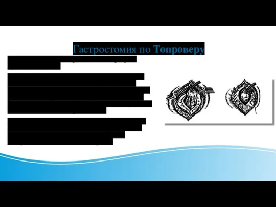 Гастростомия по Топроверу Конус желудка фиксируют к слоям разреза брюшной