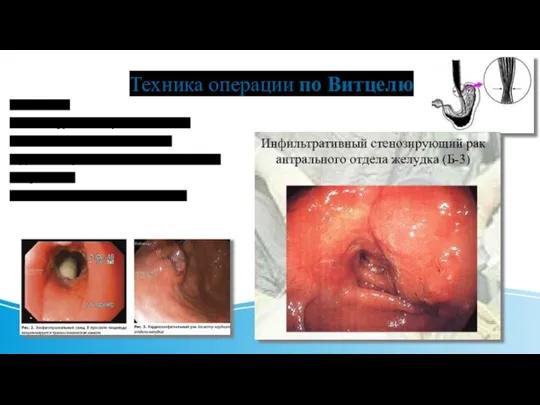 Техника операции по Витцелю Показания: 1)стенозирующие опухоли пищевода 2)и кардиального