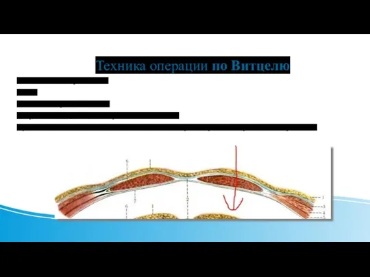 Техника операции по Витцелю Последовательно рассекают: 1)кожу 2)подкожножироваю клетчатку 3)переднию