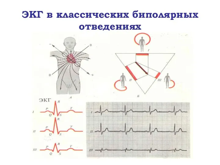 ЭКГ в классических биполярных отведениях