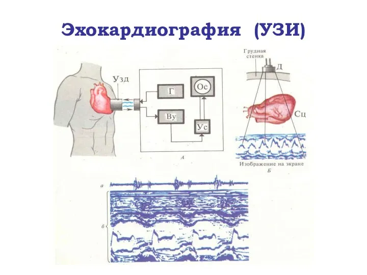 Эхокардиография (УЗИ)